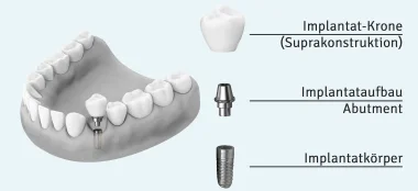 Grafik Implantataufbau