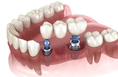 Darstellung Zahnbrücke auf Implantat