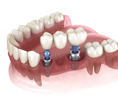 Darstellung Zahnbrücke auf Implantat