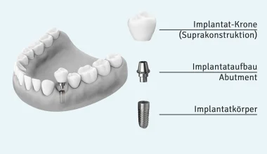 Grafik Implantataufbau