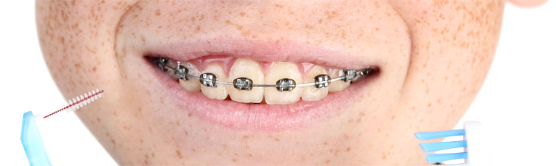 Zahnzusatzversicherung für Kieferorthopädie um Zahnspangen zu versichern