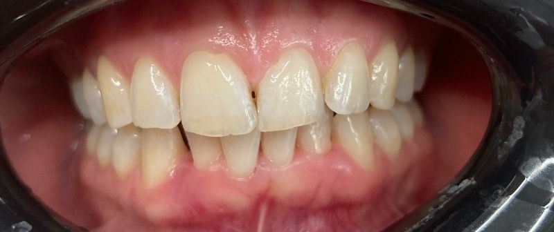 Angegriffenes Zahnfleisch eines Parodontitis Patienten