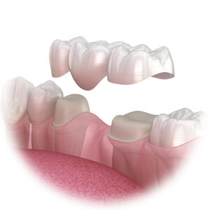 Zahnbrücke als Zahnersatz