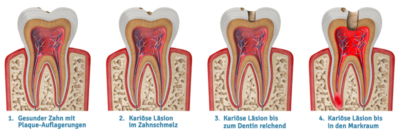Die verschiedenen Stadien des Zahnkaries