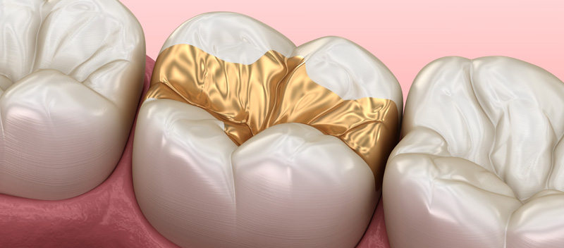 Zahnfüllungen aus Gold heben sich optisch vom Zahn ab