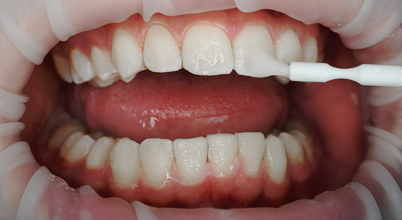 Lokale Fluoridierung durch direktes Auftragen von Fluoridgel beim Zahnarzt