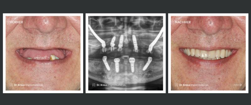 Ein vorher nachher Bild einer Zahnimplantation bei Dr Kraus Implantatklinik